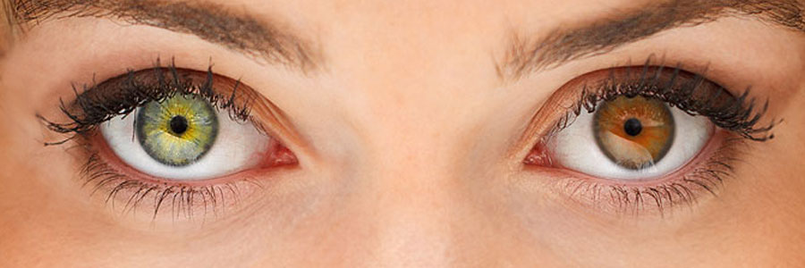Разный цвет глаз (гетерохромия).